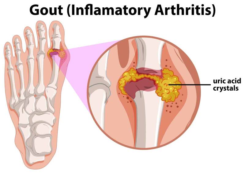 gout joint arthritis uric acide